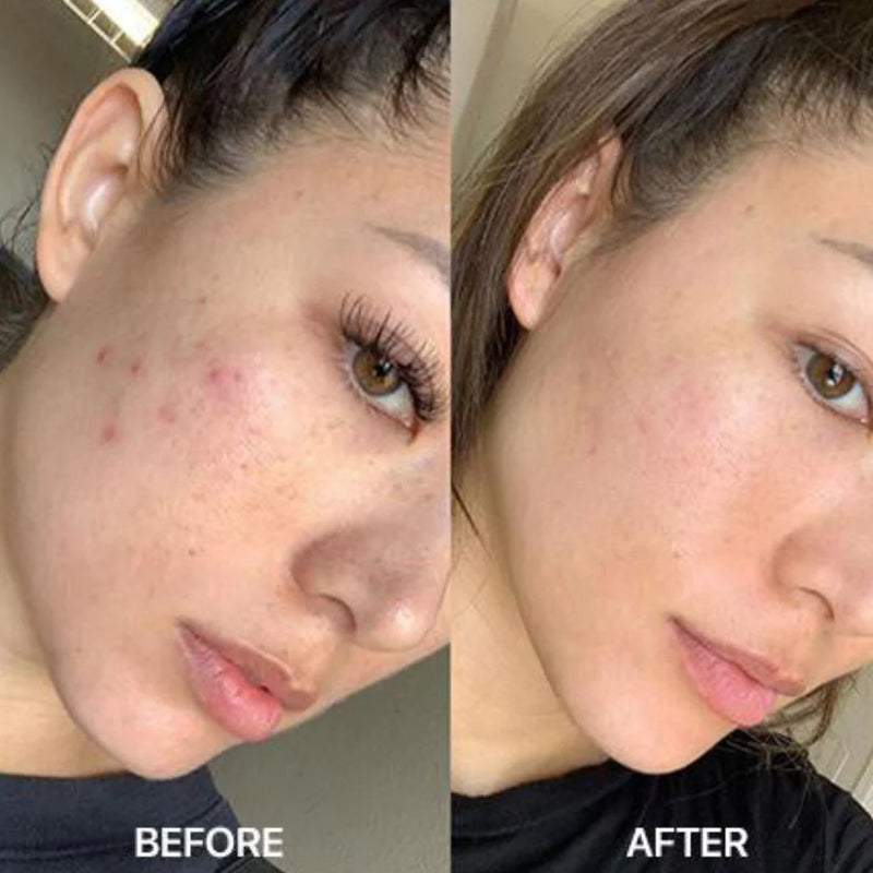 Nuvio Hochfrequenz-Akne-Stab