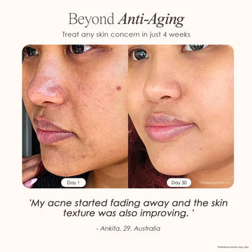 Nuvio Hochfrequenz-Akne-Stab