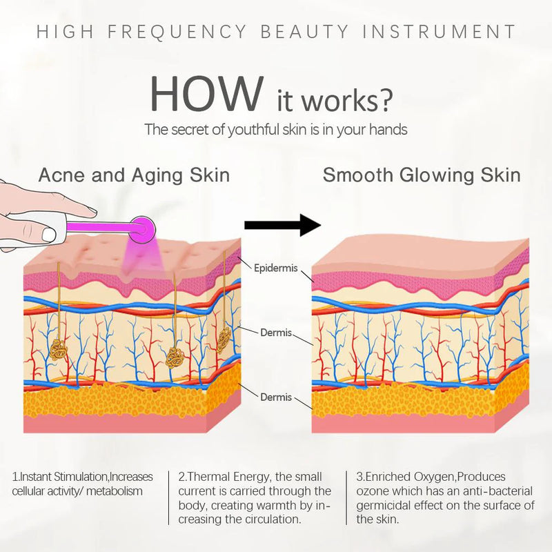 Nuvio Hochfrequenz-Akne-Stab